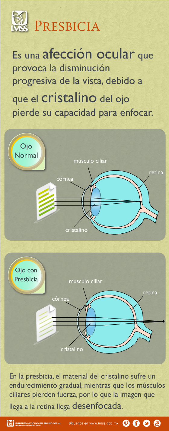 Presbicia, afección ocular